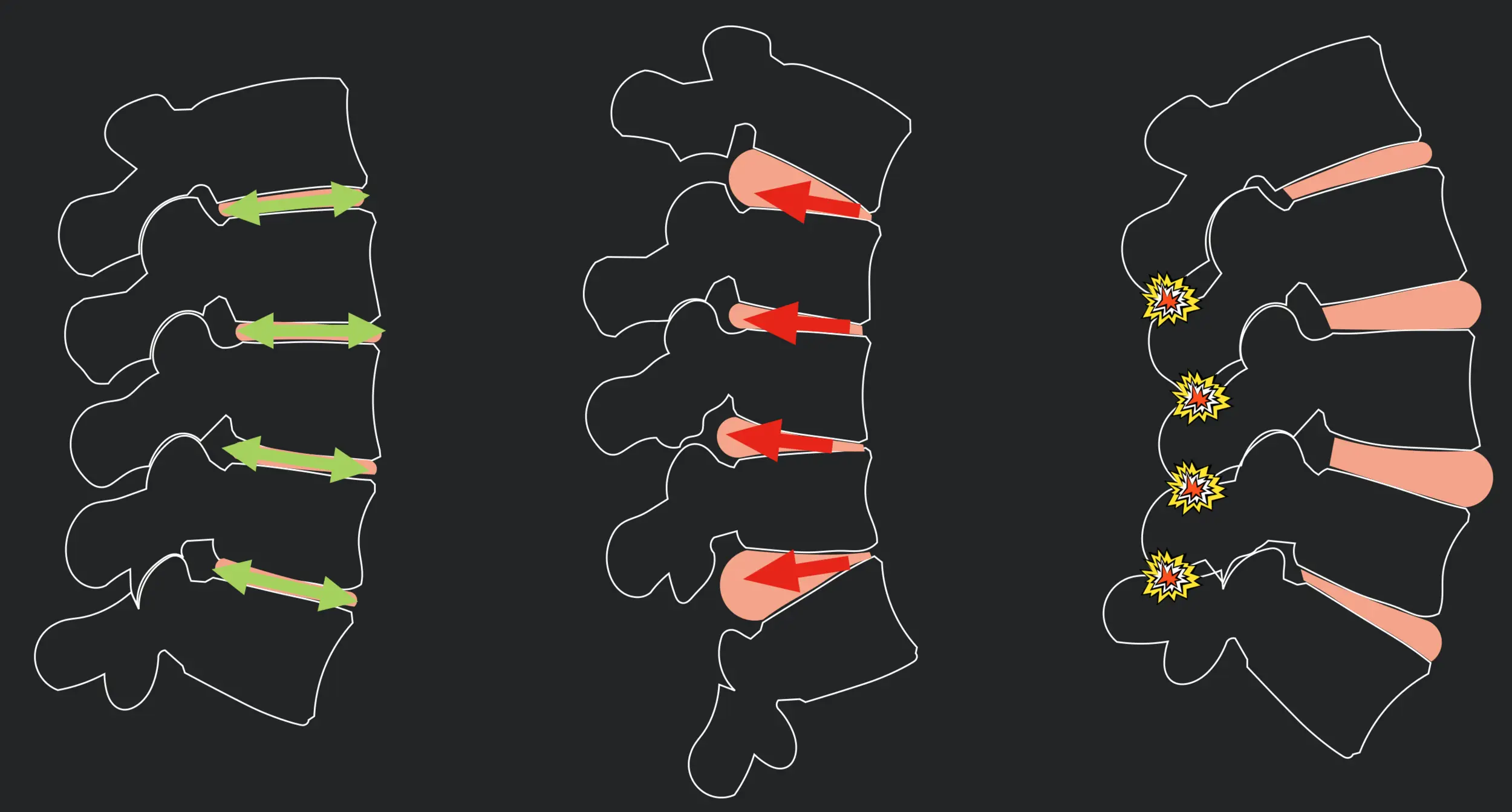 Biomechanics of the spine - posture, forces and structures